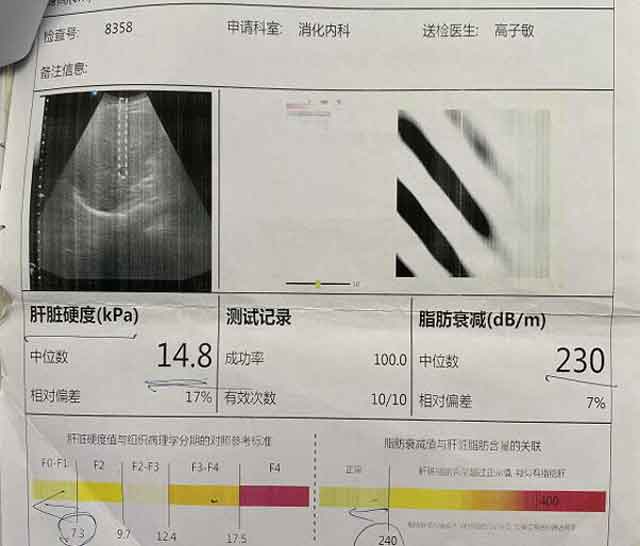 郑州看肝硬化上哪家医院?河南看肝硬化哪家医院好