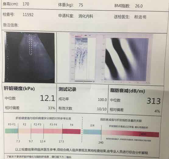 郑州肝硬化医院在线解答?郑州肝硬化哪家医院好