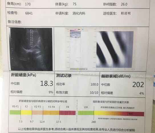 郑州肝硬化医院在线解答?郑州肝硬化哪家医院好