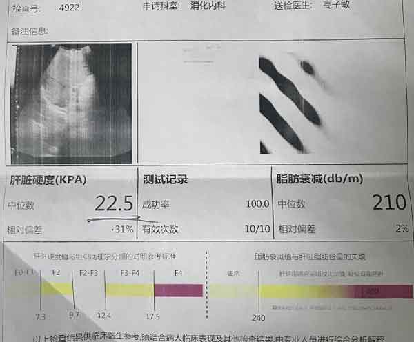 10多年乙肝史发展成肝硬化,软肝治疗两个月见疗效