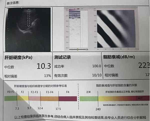 10多年乙肝史发展成肝硬化,软肝治疗两个月见疗效