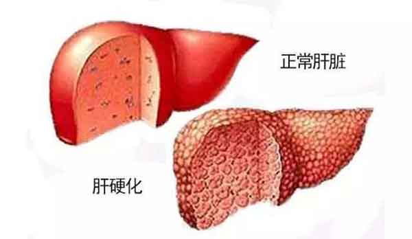 郑州乙肝大三阳哪家医院治疗好