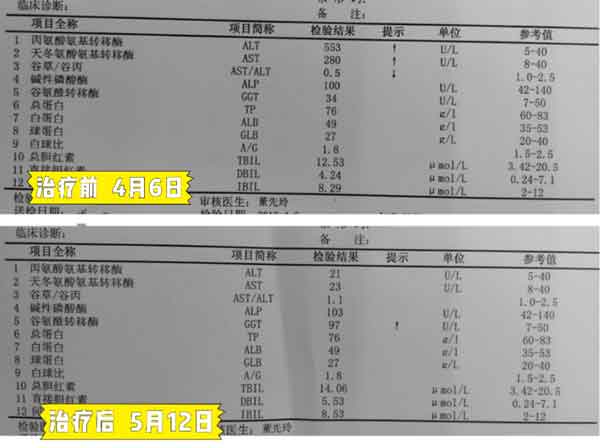 郑州乙肝大三阳哪家医院治疗好