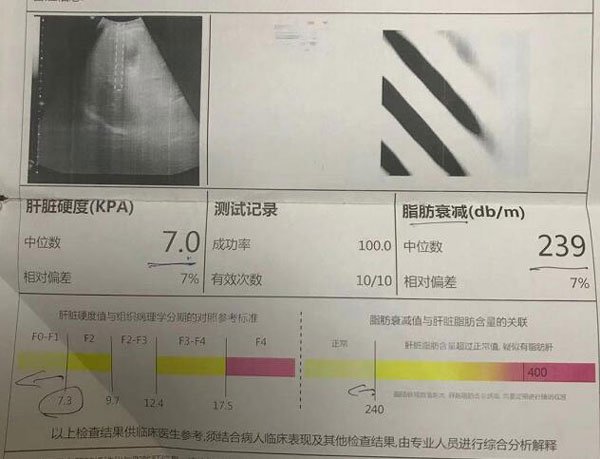 郑州那医院治肝硬化好